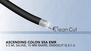 Colonoscopy: Ascending Colon SSA EMR