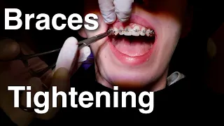 Are braces tightening appointments painful? What it feels like and loads of tips and tricks