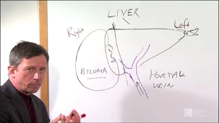 Liver Resection – Hospital Stay & Recovery | Roswell Park Patient Education