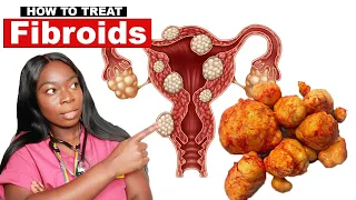 Doctor Explains: FIBROIDS | Cause, Symptoms & Treatment |Surgery, Myomectomy, Pregnancy, Infertility