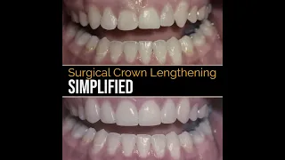 S4351 - Surgical Crown Lengthening Simplified