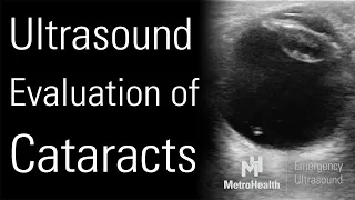 POCUS for Cataracts