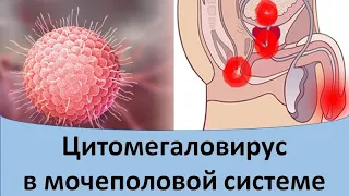 Цитомегаловирус в мочеполовой системе.