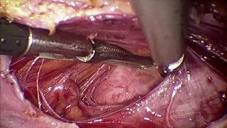 Lateral window technique for bladder separation in previous 3 LSCS TLH