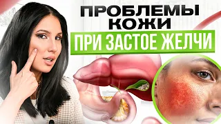 10 признаков застоя желчи на коже. Что кожа расскажет о твоем желчном?