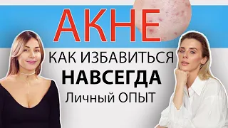 АКНЕ от А до Я. Вебинар с косметологом.