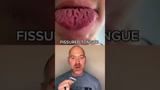 Fissured Tongue #shorts