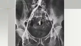 Imaging of Femoral Artery   Prof Dr  Hassan El kiki In Arabic