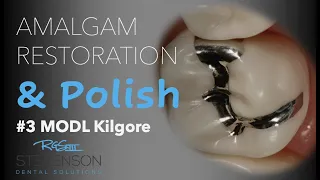 Amalgam Restoration and Polish #3 MOL Kilgore