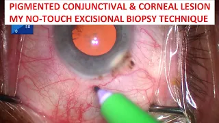 Pigmented Conjunctival & Corneal Lesion: My No-Touch Excisional Biopsy Technique