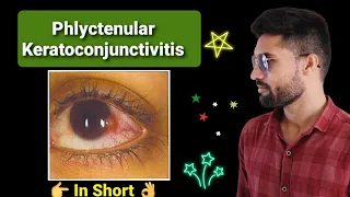 Phlyctenular keratoconjunctivitis lecture opthalmology