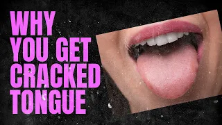 "Cracked Tongue," why it occurs and ways to prevent it.