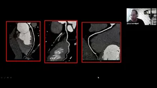 Clase 15 - Angiotomografía en la enfermedad coronaria