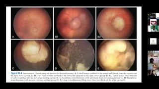 PHO training session 28.05.2020: RETINOBLASTOMA