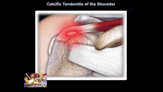 Calcific Tendonitis of the shoulder - Everything You Need To Know - Dr. Nabil Ebraheim