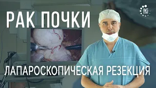 Рак почки. Лапароскопическое удаление опухоли почки