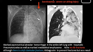 6 chest Trauma - prof.Mamdouh Mahfouz (2019 edition)