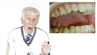 Tongue Splinting By Prof John Mew