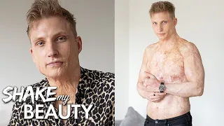 I Was Electrocuted And Burned 70% Of My Body | SHAKE MY BEAUTY