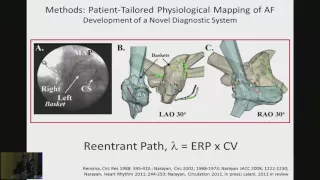 Debate estragegia ablación FA persistente presentación Dr. Kalyanam Shivkumar