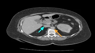Clinical Case: Renal Cell Carcinoma