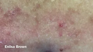 Christian's  Acne Back Treatment  (Blackheads Extractions)