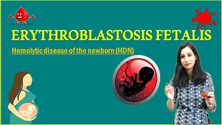 ERYTHROBLASTOSIS FETALIS II Hemolytic disease of the newborn (HDN)