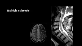 Imaging of Spinal infection   Prof  Dr  Mamdouh Mahfouz