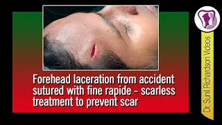 Forehead laceration from accident sutured with fine rapide - scarless treatment to prevent scar