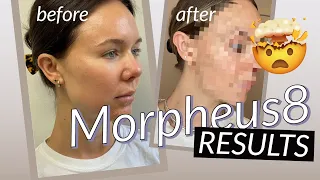 MORPHEUS 8 RESULTS BEFORE & AFTER | POSTPARTUM GLOW UP PLAN