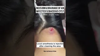 Incision and Drainage of a Sebaceous vs Epidermoid Cyst #shorts