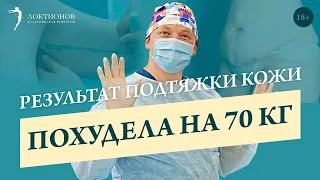 Кожа после похудения на 70 кг // 18+