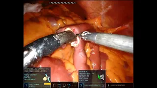 Robotic Jejunojejunostomy Creation Utilizing ICG