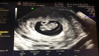 [8 Weeks Pregnant] First 3D Ultrasound with Heartbeat