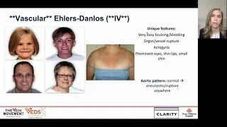 Morristown Hospital Pediatric Grand Rounds Vascular Ehlers-Danlos Syndrome