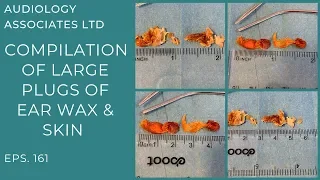 COMPILATION OF LARGE PLUGS OF EAR WAX & SKIN - EP161