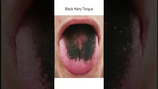 "Normal" Tongue Variations - Do not HAVE to be treated though some may choose to pursue treatment