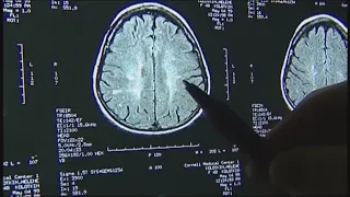 Study indicates COVID-19 causes brain damage, even in mild cases