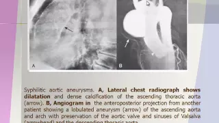 Imaging of Aorta 2   Prof Dr  Hassan El kiki In Arabic