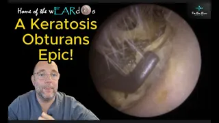 A Keratosis Obturans Epic! 177 #ear #earwax #earwaxremoval #earclean #asmr #asmrearwax #keratosis