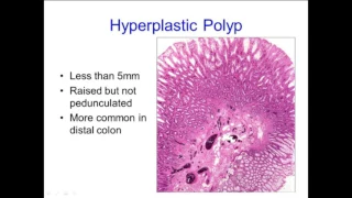Hyperplastic Polyps: Not Always What They Seem