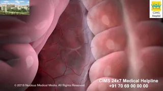 Laparoscopic Colectomy – CIMS Hospital