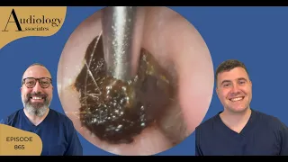 PERFECTLY FORMED EAR WAX PLUG REMOVAL - EP865