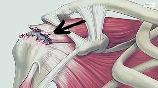 😩 Dolore di spalla: ecco il modo per non finire sotto i ferri 👨‍⚕️