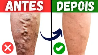 5 GREAT DRINKS to COMBAT POOR CIRCULATION, VARIOUS VARCES and LEG PAIN