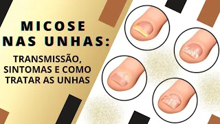 Micose nas unhas: transmissão, sintomas e como tratar as unhas