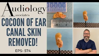 COCOON OF EAR CANAL SKIN REMOVED - EP574