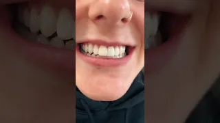 whitening before and after