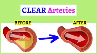 Top 10 Foods That Unclog Arteries and Protect Your Heart