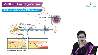 Guillain Barre Syndrome (Hindi) - Internal Medicine